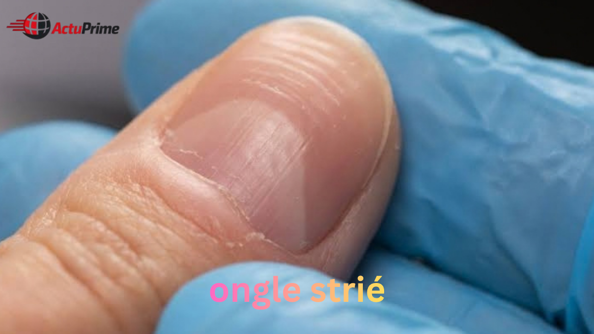ongle strié